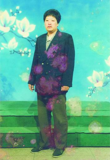 血小板减少症康复患者李连英